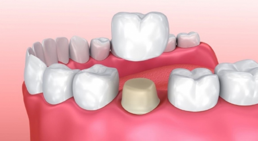 Как выглядит несъемное протезирование зубов