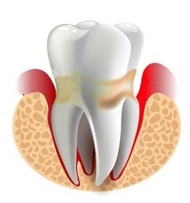 periodontitis 1 1