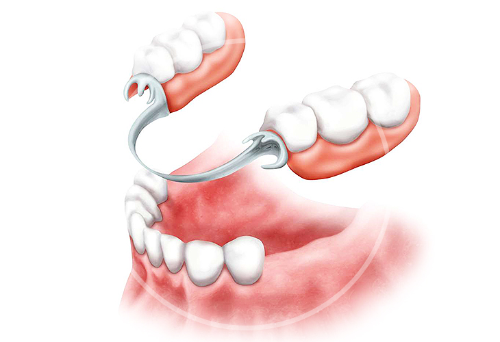 Какие бывают зубные протезы